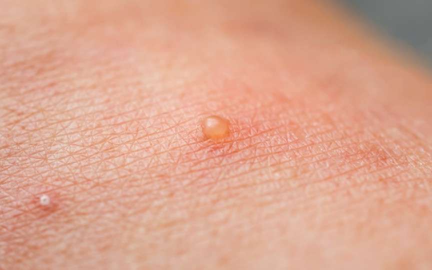 Dishidroza la copii, vara: cum să gestionați și să preveniți erupțiile