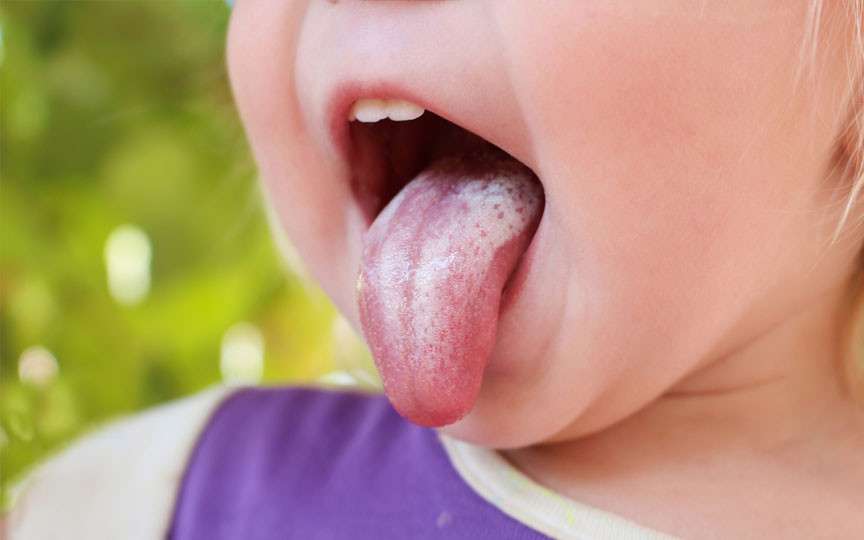Limba albă la copii: semn normal sau semnal de alarmă?