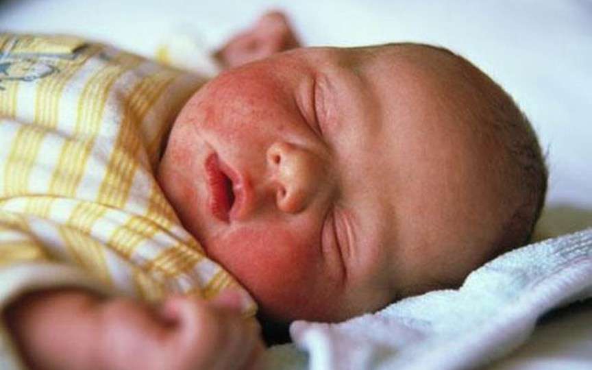 Cum a stopat o mămică dermatita atopică a copilului, fără a recurge la medicamente