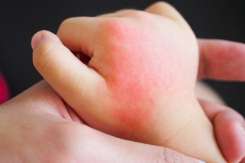 Medic dermatolog despre cum recunoaștem alergia solară la copii