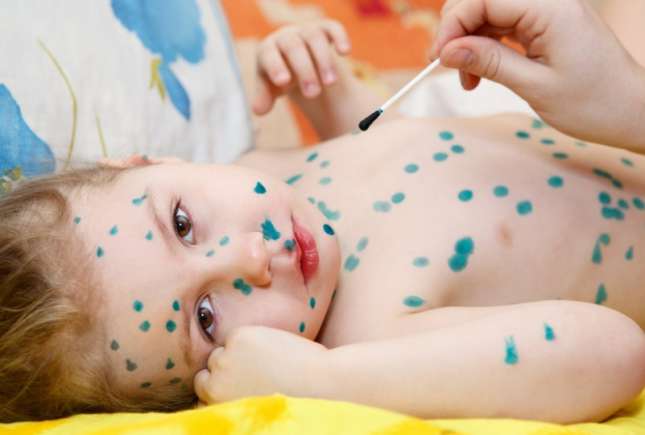 Ce să NU facem în cazul în care copilul are varicelă – Nu petreceri cu varicelă, ci izolare strictă