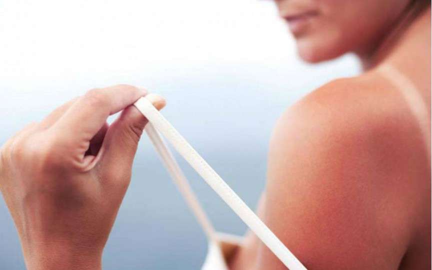 Sfaturi utile: remedii naturiste care ajută împotriva arsurilor solare