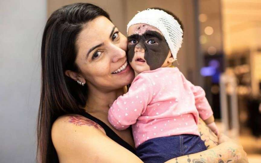 Minune în cazul fetiţei născute cu „masca lui Batman” pe faţă. Iată cum arată acum micuţa, după şedinţele de tratament