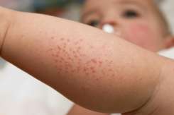 Medic pediatru-alergolog: Copilul poate avea un șoc anafilactic de la pește sau arahide chiar dacă nu le-a consumat
