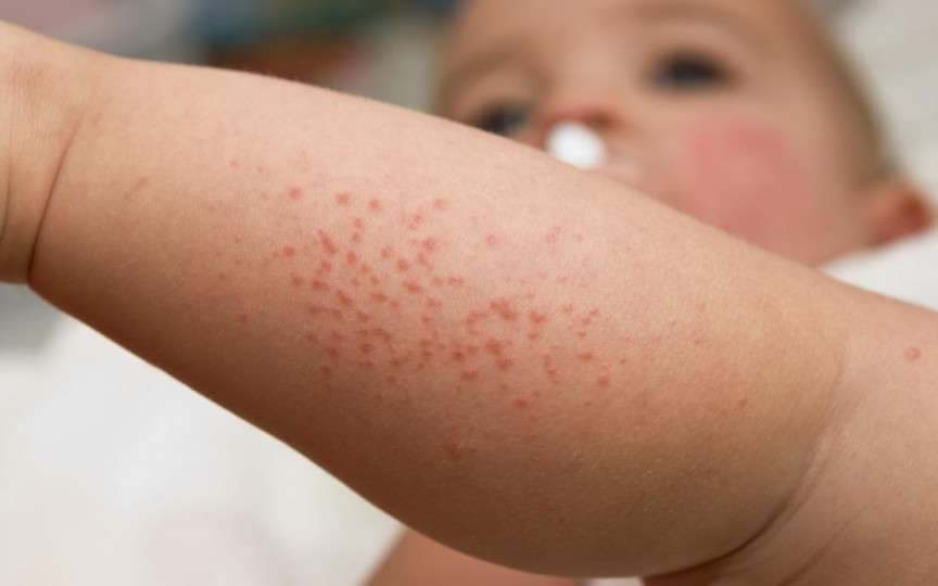 Medic pediatru-alergolog: Copilul poate avea un șoc anafilactic de la pește sau arahide chiar dacă nu le-a consumat