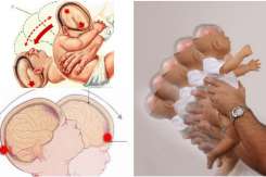 Medic neonatolog: Se atestă o creștere a cazurilor de sindrom al copilului zgâlțâit