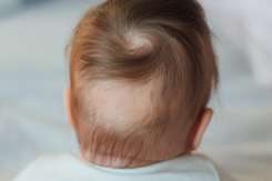 Cauzele căderii părului (alopecia), la bebeluși și copii