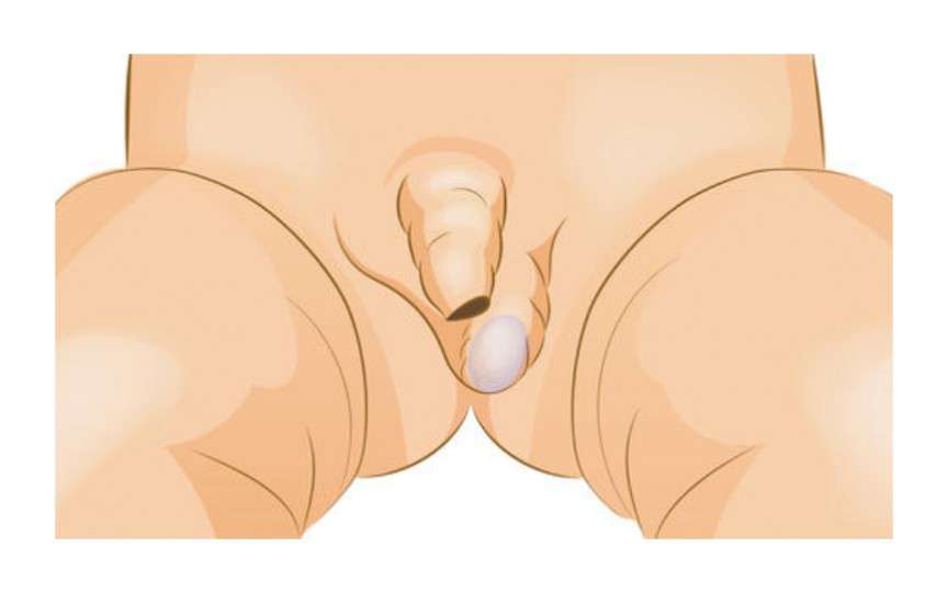 Testiculul necoborât – netratată la timp, afecțiunea poate duce la infertilitate și cancer