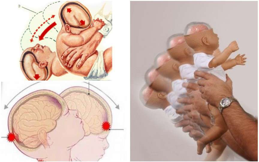 Medic neonatolog: Se atestă o creștere a cazurilor de sindrom al copilului zgâlțâit