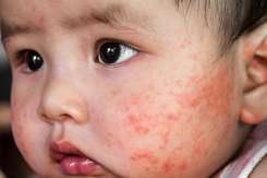 Medic: Dermatita atopică pornește de la curățenia exagerată. Cum se spală corect un bebeluș și hainele lui