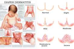 Dermatita de scutec, pe înțelesul părinților – sfaturi practice de la medic pediatru