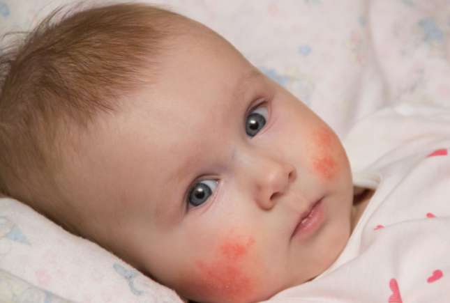 Cauzele apariției dermatitei atopice și cum se tratează