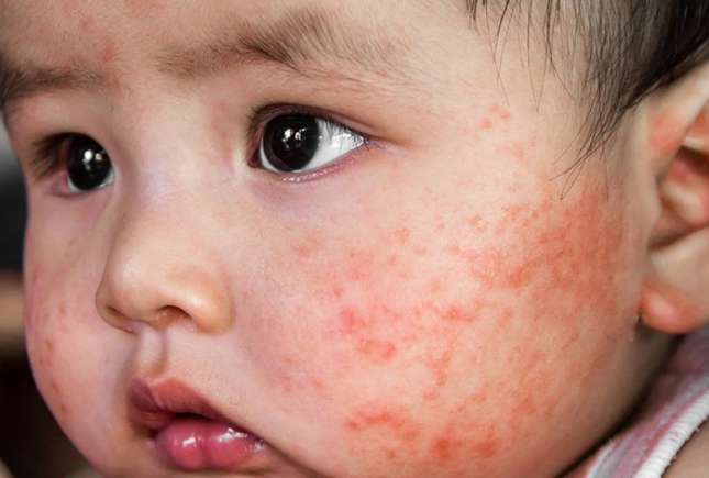 Medic: Dermatita atopică pornește de la curățenia exagerată. Cum se spală corect un bebeluș și hainele lui