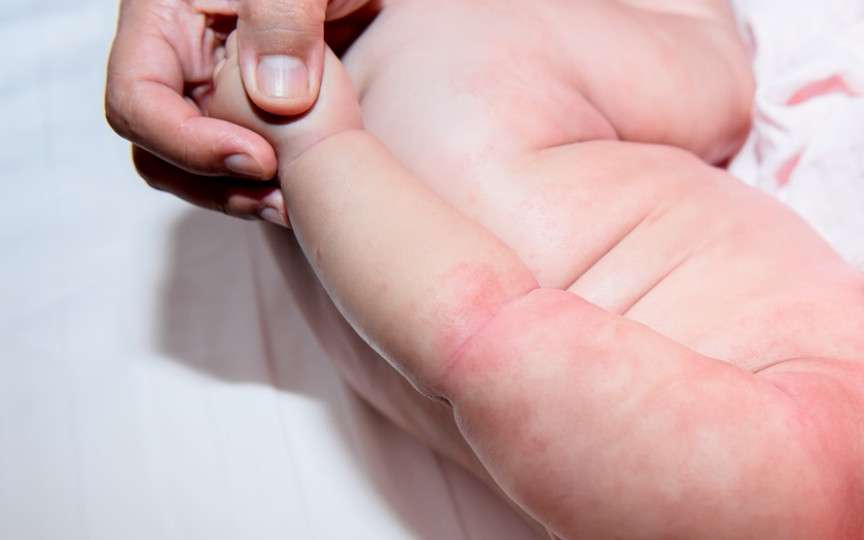 Iritația din cauza căldurii, la bebeluși. Cauze, prevenție și tratament