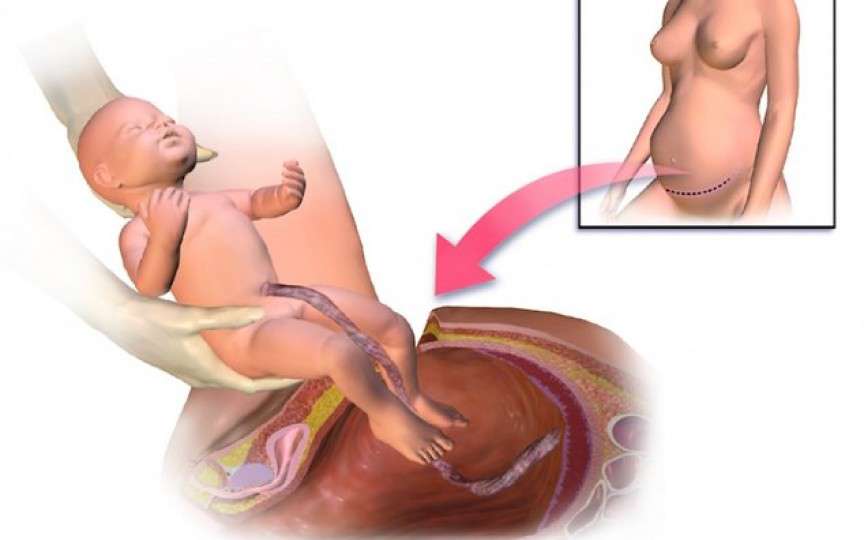 Numărul moldovencelor care nasc prin cezariană este în creștere. Iată cauzele!