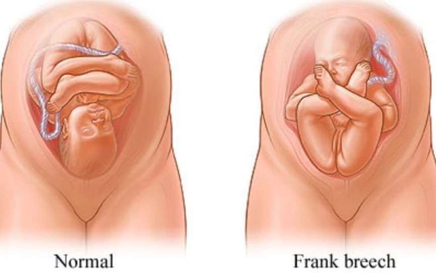 Medic primar obstetrică-ginecologie despre pozițiile bebelușului în timpul nașterii și ce complicații pot provoca