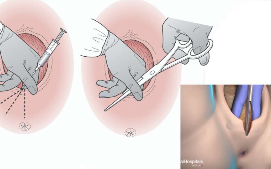 Tăierea peretelui vaginal la nașterea naturală – când este necesară?