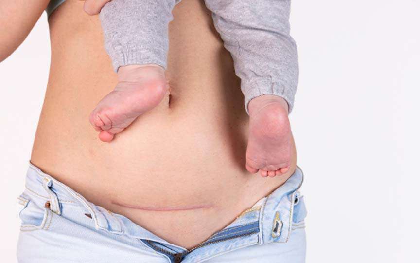 7 Mituri despre nașterea prin cezariană – Ce este adevărat și ce nu?