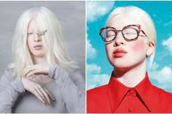 Istoria fetiței care a fost abandonată pentru că s-a născut cu albinism. Acum este un model de succes