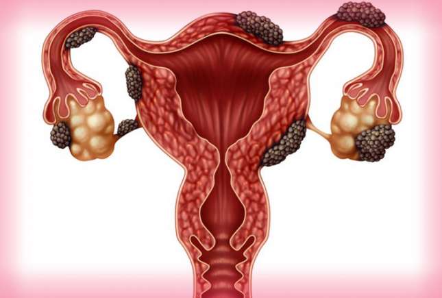 Endometrioza profundă - cauză de infertilitate