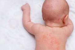 Dermatita de scutec: greșelile pe care le fac părinții fără să-și dea seama