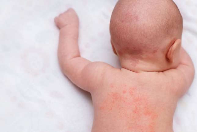 Dermatita de scutec: greșelile pe care le fac părinții fără să-și dea seama