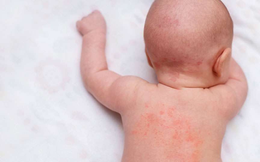 Dermatita de scutec: greșelile pe care le fac părinții fără să-și dea seama
