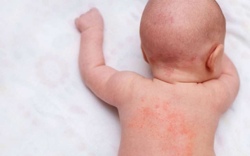 Bubițe de căldură la nou-născuți: cum le recunoști, cauze, tratament și prevenție