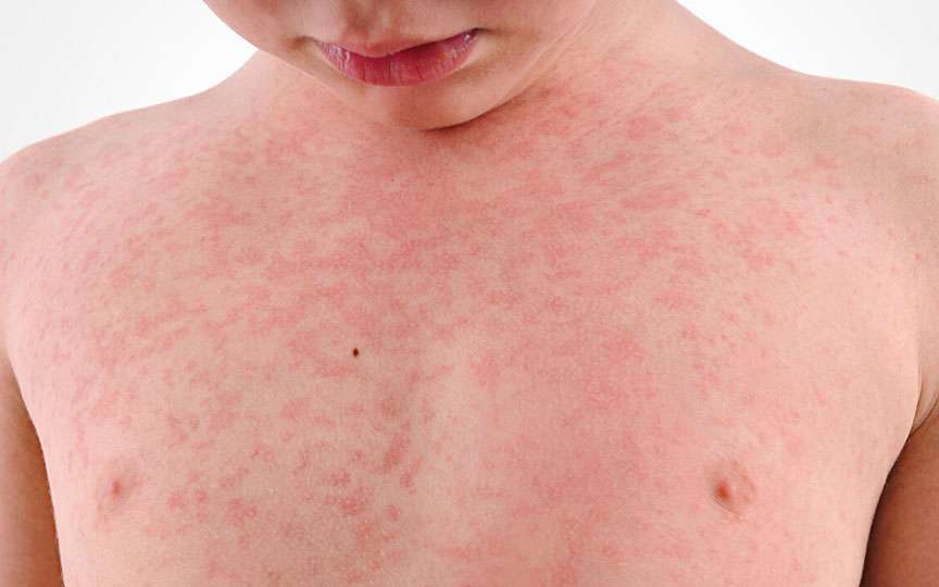 Erupțiile cutanate la copii: cum deosebim miliaria de alergie