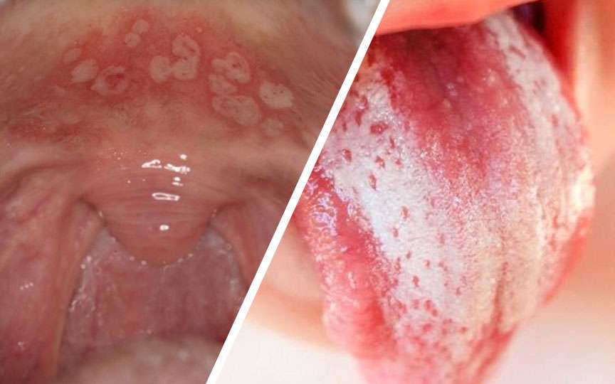 Simptome orale la copii: limbă albă, depuneri colorate, afte și „perle” pe cerul gurii – când trebuie mers la medic