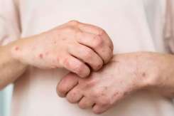 Rubeola la copii: simptome, tratament și prevenție