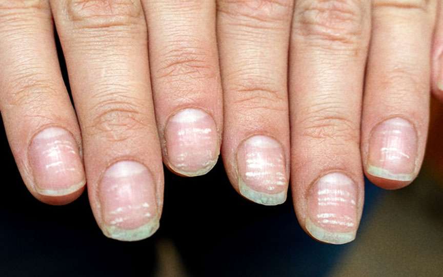 Deficitul de fier la femei: cauze, simptome și soluții eficiente