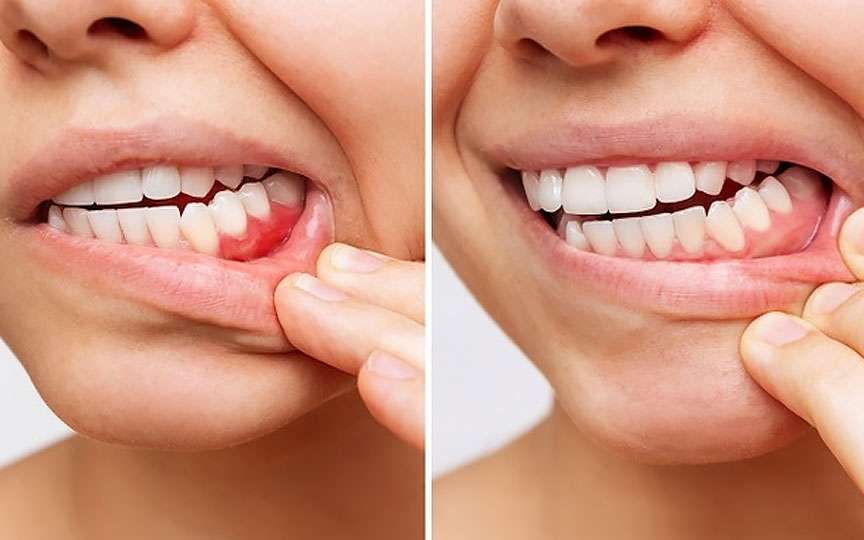 Gingivita la adulți și copii: cauze, simptome, tratament și prevenție