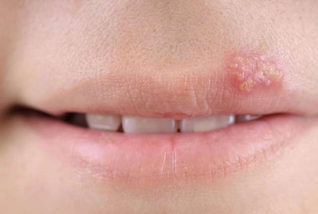 Herpes pe buze: cauze, tratament și prevenție