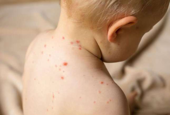 Rujeola în Moldova: aproape 200 de cazuri în 2025. ANSP avertizează că vaccinarea este esențială