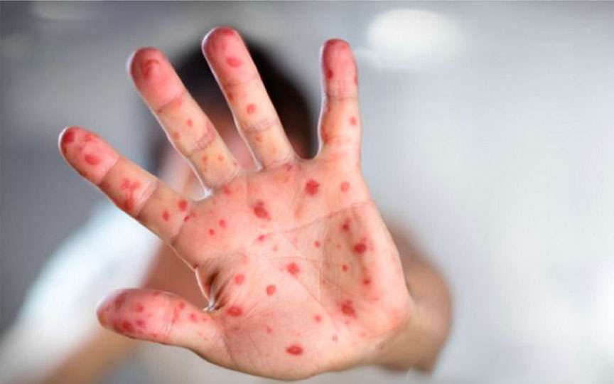 10 mituri periculoase despre rujeolă explicate de medici