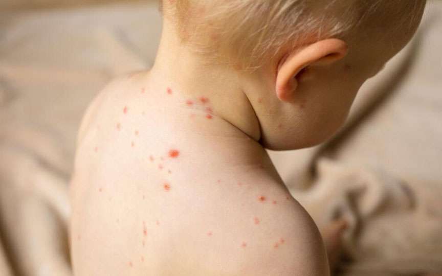 Rujeola în Moldova: aproape 200 de cazuri în 2025. ANSP avertizează că vaccinarea este esențială