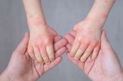 Urticaria la copii: cauze, simptome, tratament și semne care necesită ajutor urgent