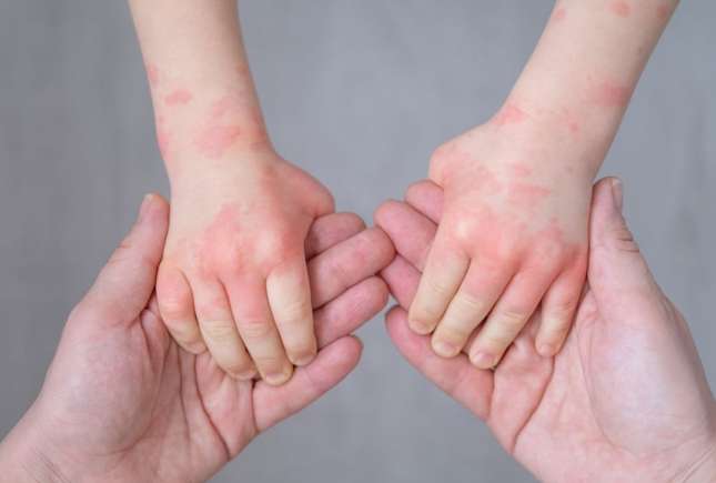 Urticaria la copii: cauze, simptome, tratament și semne care necesită ajutor urgent