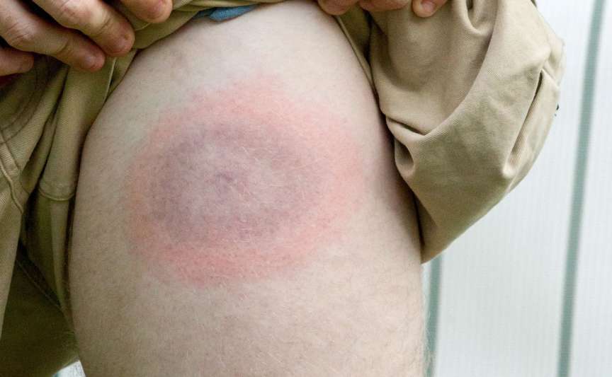 Boala Lyme și toxiinfecții alimentare în creștere la Chișinău: ce arată datele recente