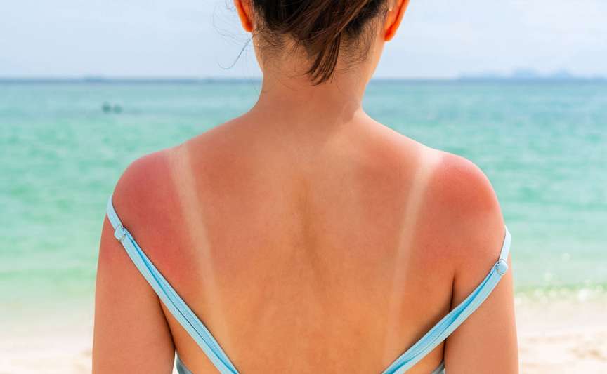 Arsurile solare repetate pot dubla riscul de cancer de piele, avertizează specialiștii
