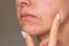 Ce este dermatita periorală la nivelul feței și care sunt opțiunile de tratament