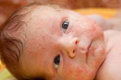 Veziculopustuloza la nou-născuți – simptome, diagnostic și tratament