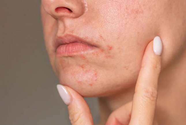 Ce este dermatita periorală la nivelul feței și care sunt opțiunile de tratament