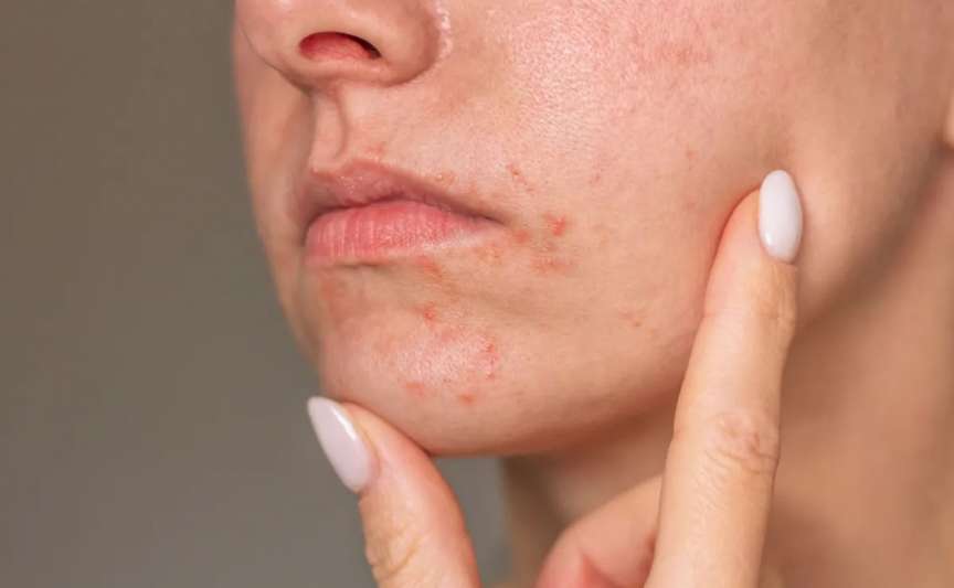 Ce este dermatita periorală la nivelul feței și care sunt opțiunile de tratament