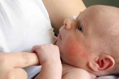 Dermatita atopică la copii: cum o recunoști și cu ce nu trebuie confundată