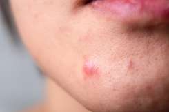 Cum tratezi acasă un coș inflamat: sfaturi dermatologice utile