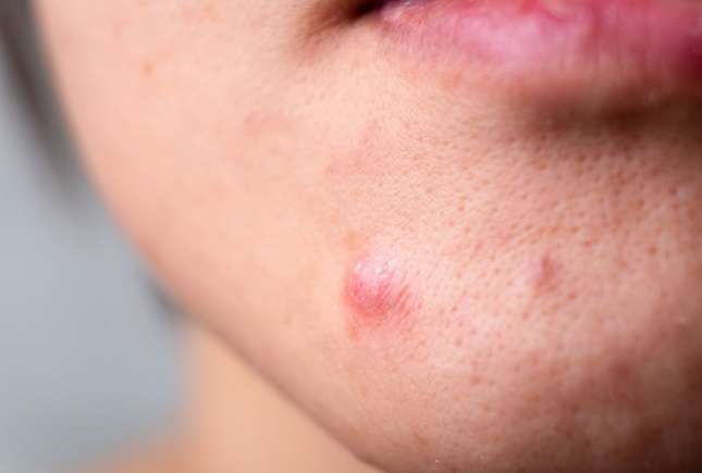 Cum tratezi acasă un coș inflamat: sfaturi dermatologice utile