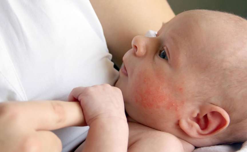 Dermatita atopică la copii: cum o recunoști și cu ce nu trebuie confundată