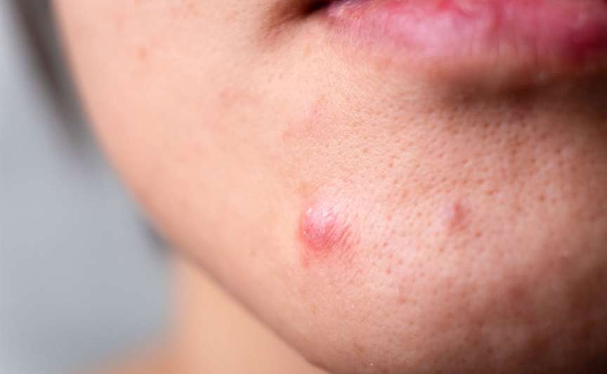 Cum tratezi acasă un coș inflamat: sfaturi dermatologice utile